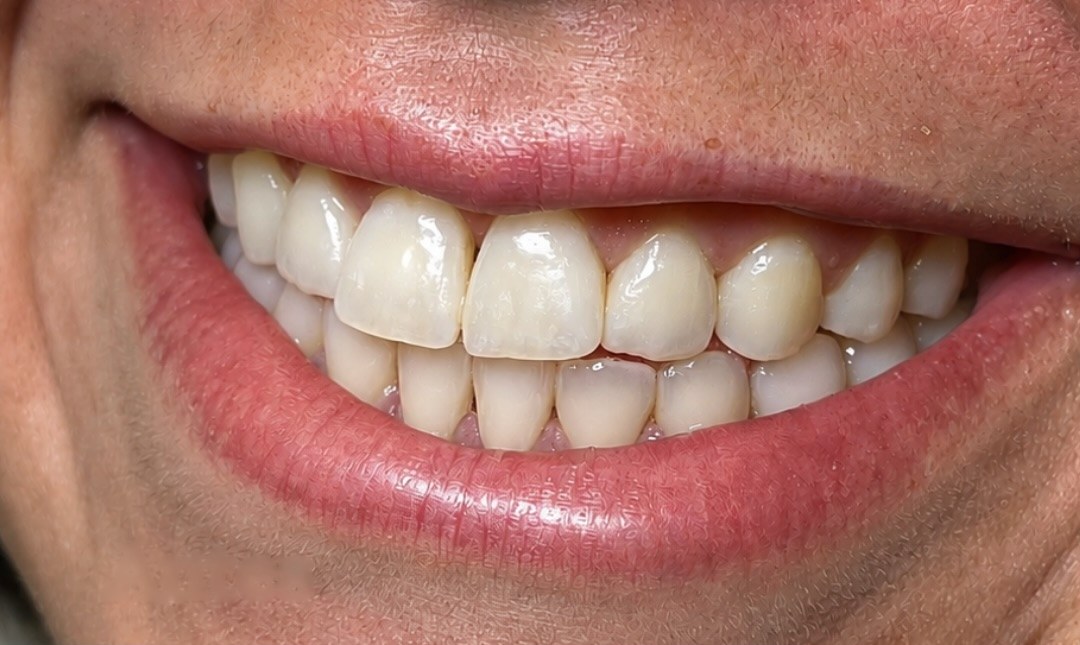 Sorriso do paciente 2 antes das facetas
