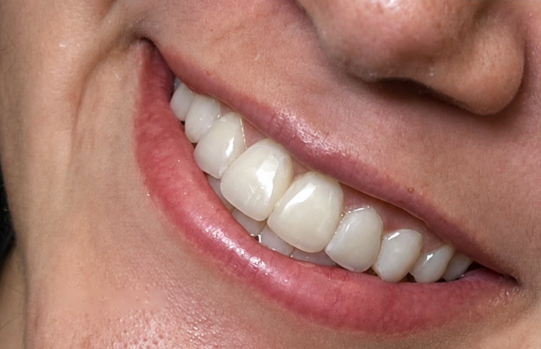 Sorriso do paciente 2 depois das facetas
