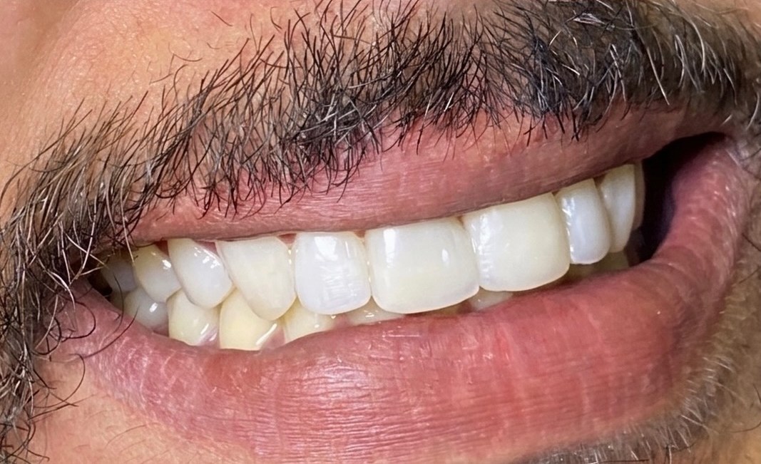 Sorriso do paciente 3 depois das facetas