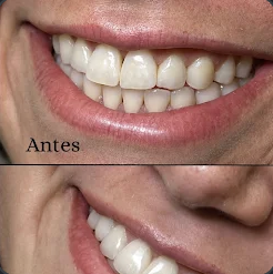 Foto de antes e depois do sorriso de Sara Souza