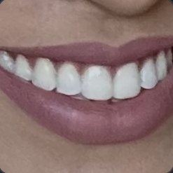 Foto do sorriso de Yasmim Vieira após as facetas